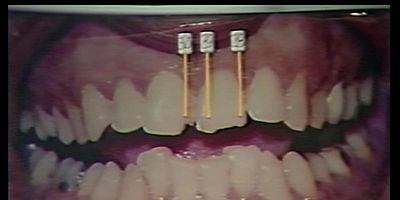 Cartel de Arde, Bundy, arde